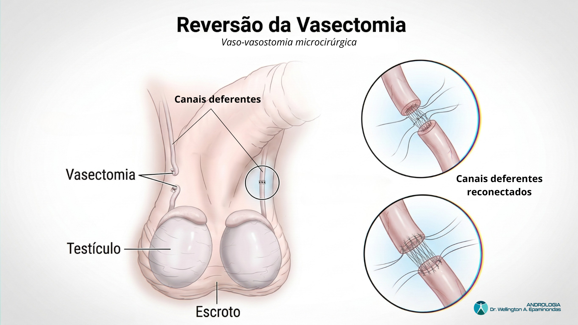 Ilustração da técnica de Reversão de Vasectomia (Vaso-vasostomia)